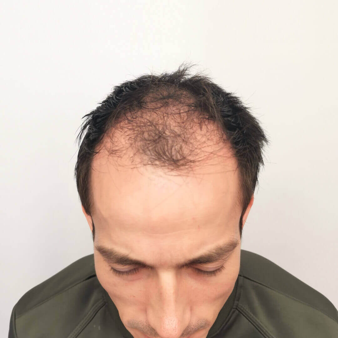 Transplantácia vlasov pred-po: Gregor - PHAEYDE Clinic Bratislava