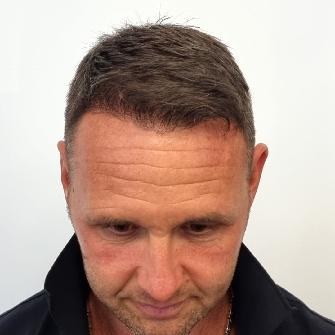 Transplantácia vlasov pred-po: Jozef - PHAEYDE Clinic