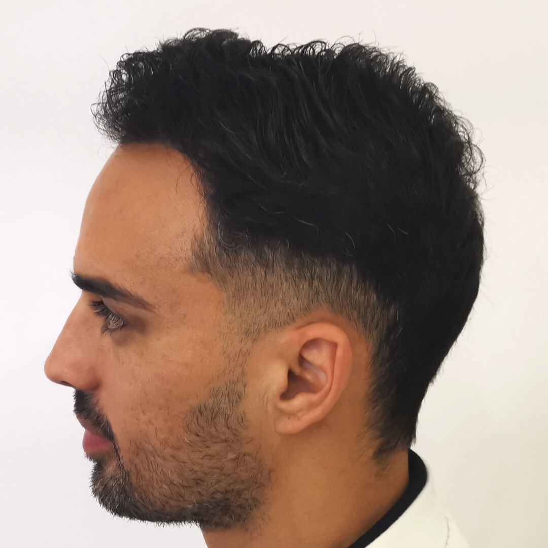 Transplantácia vlasov pred-po: Lucas - PHAEYDE Clinic Bratislava