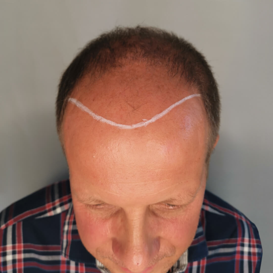 Transplantácia vlasov pred-po: Marcel - PHAEYDE Clinic
