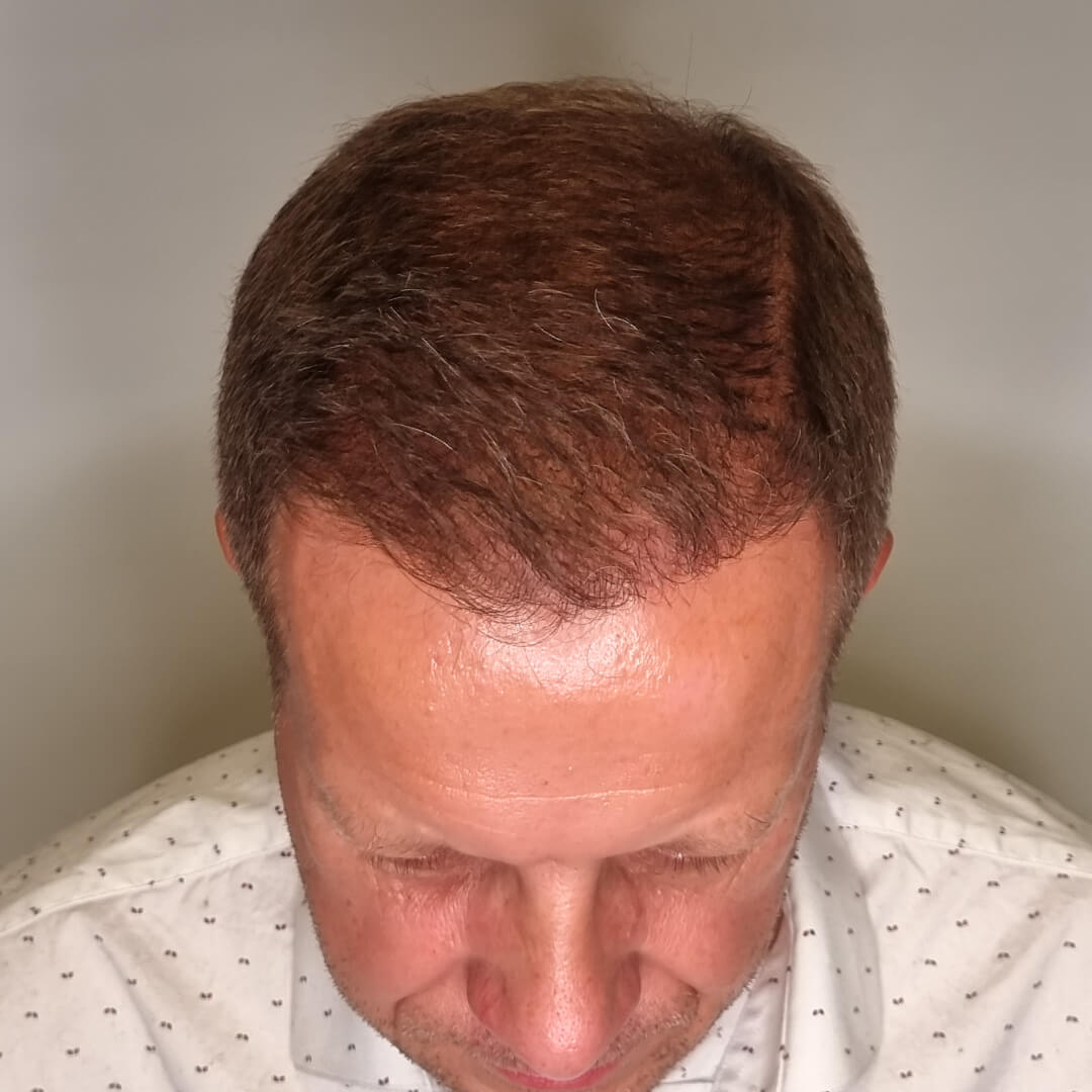 Transplantácia vlasov pred-po: Marcel - PHAEYDE Clinic