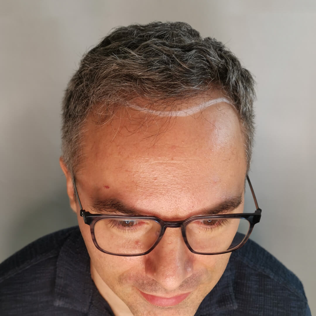 Transplantácia vlasov pred-po: Pavel - PHAEYDE Clinic