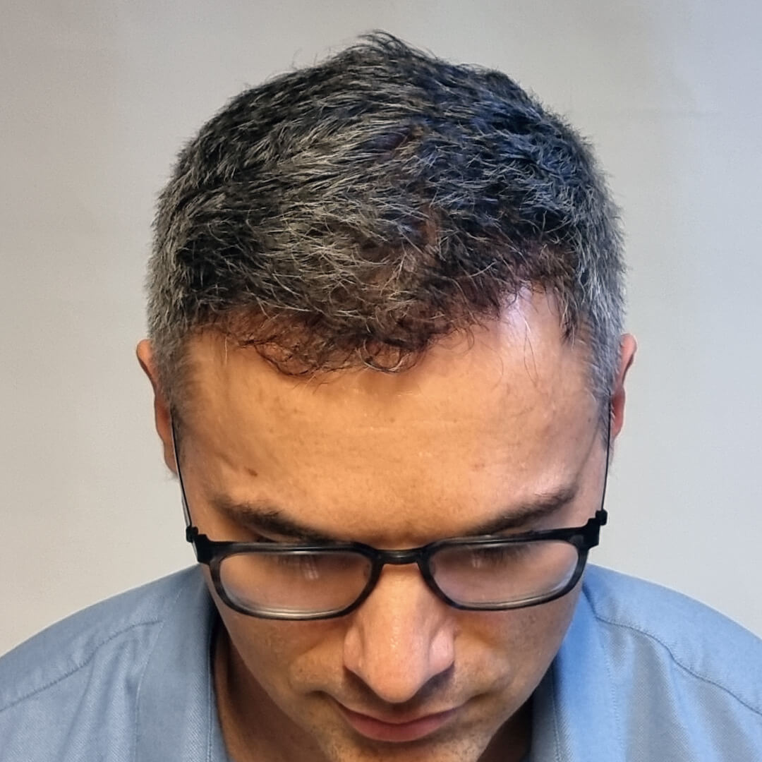 Transplantácia vlasov pred-po: Pavel - PHAEYDE Clinic