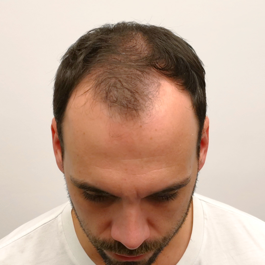 Transplantácia vlasov pred-po: Peter - PHAEYDE Clinic Bratislava